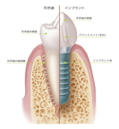 インプラント