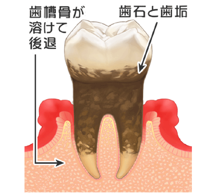 歯周病の分類